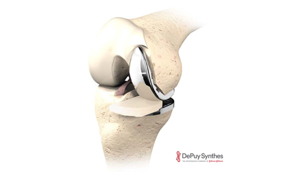 Bild: DePuySynthes